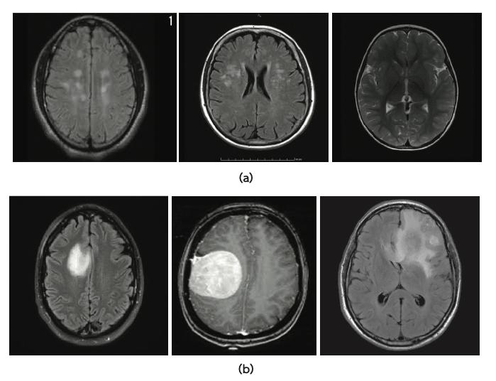 brain-mri-classification